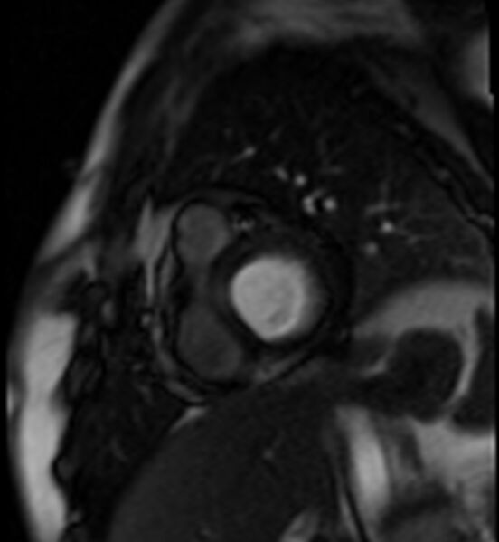 File:Acute anteroseptal myocardial infarction (Radiopaedia 68409-77945 Short axis (basal) Perfusion 10).jpg