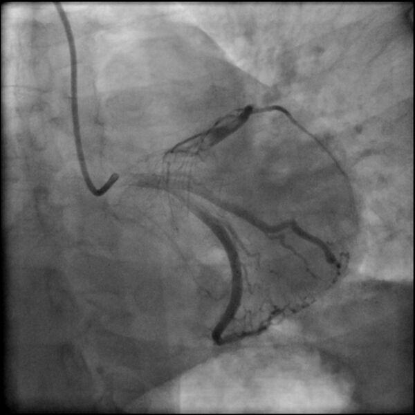 File:Acute anteroseptal myocardial infarction (Radiopaedia 68409-77946 LAO caudal (spider view) LAD and CX 45).jpg
