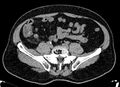Acute appendicitis (Radiopaedia 13030-13091 Axial non-contrast 16).jpg