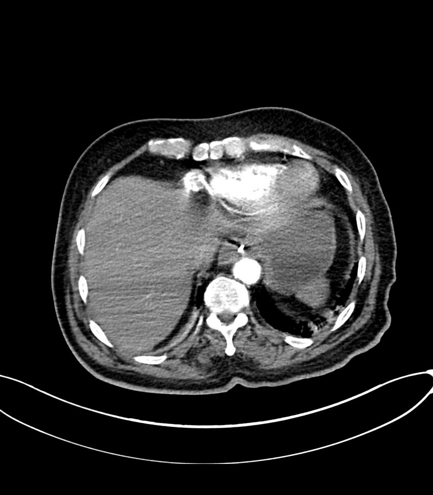 Acute arterial mesenteric ischemia (Radiopaedia 78238-90828 Axial C+ arterial phase 24).jpg