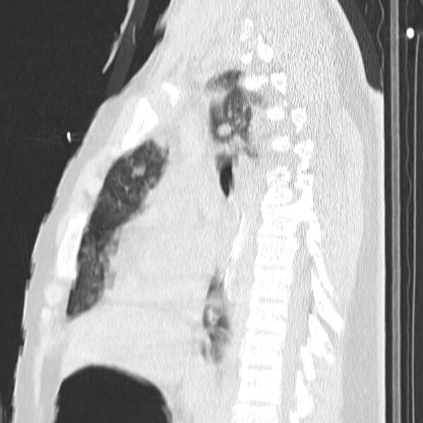 File:Acute aspiration pneumonitis (Radiopaedia 33605-34703 Sagittal lung window 43).jpg
