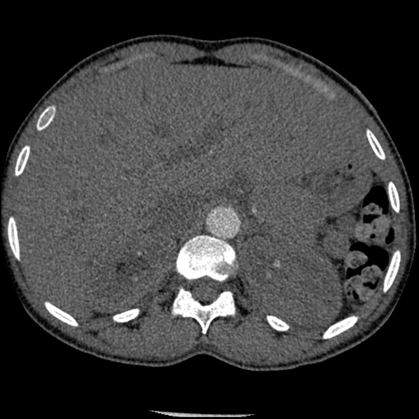 Acute chest syndrome - sickle cell disease (Radiopaedia 42375-45499 Axial C+ CTPA 200).jpg