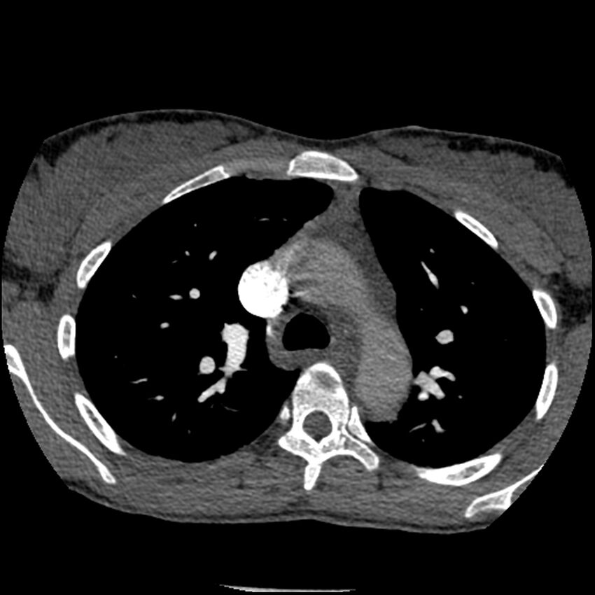 Acute chest syndrome - sickle cell disease (Radiopaedia 42375-45499 Axial C+ CTPA 62).jpg