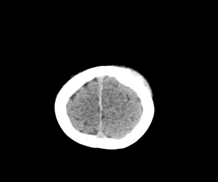 File:Acute epidural hematoma (Radiopaedia 63659-72335 Axial non-contrast 25).jpg