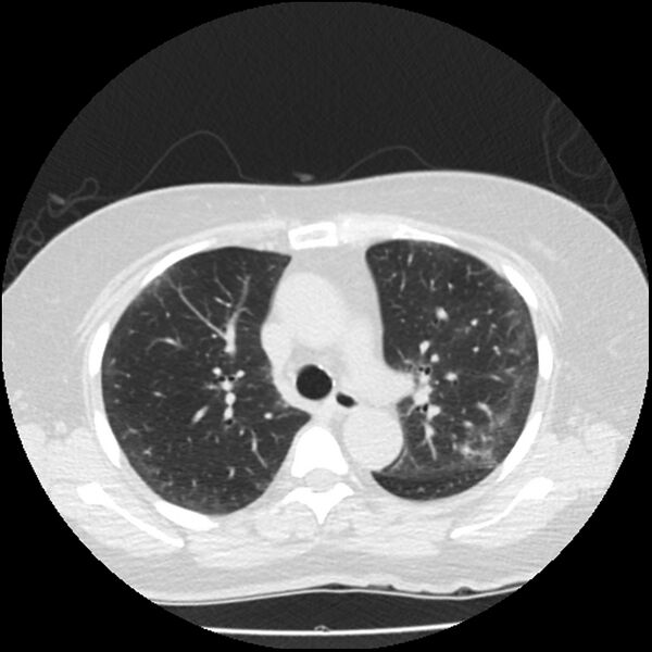 File:Acute interstitial pneumonitis (Radiopaedia 45404-49444 Axial lung window 38).jpg