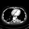 Acute myocardial infarction in CT (Radiopaedia 39947-42415 Axial C+ arterial phase 97).jpg