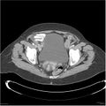 Acute pancreatitis (Radiopaedia 19136-19117 Axial C+ portal venous phase 39).jpg