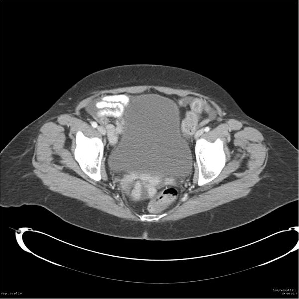 File:Acute pancreatitis (Radiopaedia 19136-19117 Axial C+ portal venous phase 39).jpg