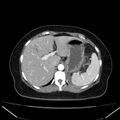 Acute pancreatitis - Balthazar C (Radiopaedia 26569-26714 Axial C+ arterial phase 20).jpg