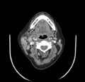 Acute parotitis (Radiopaedia 27425-27619 Axial C+ portal venous phase 33).png