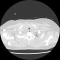 Acute pulmonary edema on CT (Radiopaedia 33582-34672 Axial lung window 2).jpg