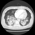 Acute pulmonary edema on CT (Radiopaedia 33582-34672 Axial lung window 36).jpg