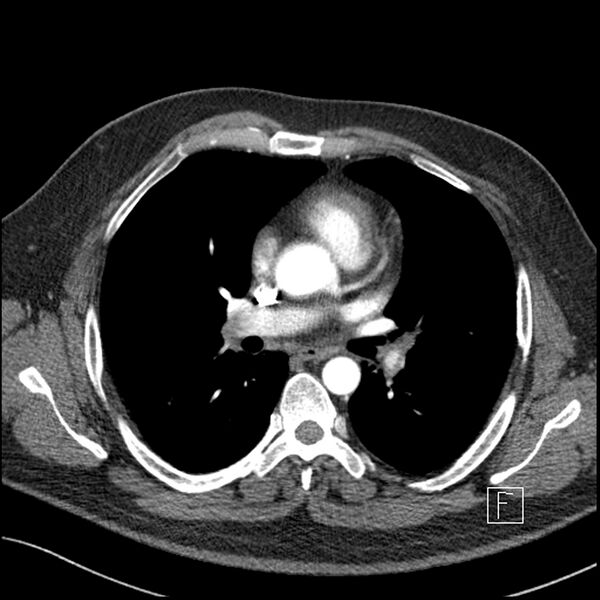 File:Acute pulmonary embolism with pulmonary infarct (Radiopaedia 73062-83768 Axial C+ CTPA 36).jpg
