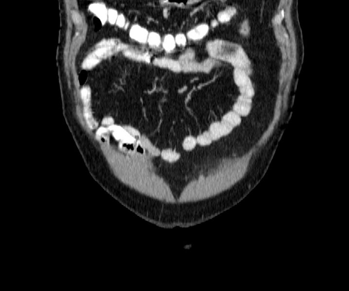 File:Acute sigmoid colon diverticulitis (Radiopaedia 55507-61976 Coronal C+ portal venous phase 3).jpg