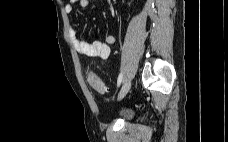 File:Acute sigmoid colon diverticulitis (Radiopaedia 55507-61976 Sagittal C+ portal venous phase 51).jpg