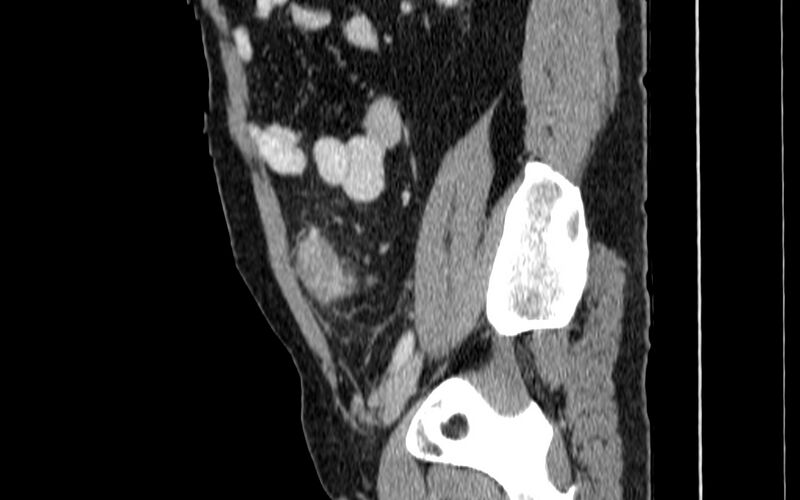 File:Acute sigmoid colon diverticulitis (Radiopaedia 55507-61976 Sagittal C+ portal venous phase 68).jpg