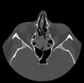 Acute sinusitis (Radiopaedia 23161-23215 Axial bone window 39).jpg