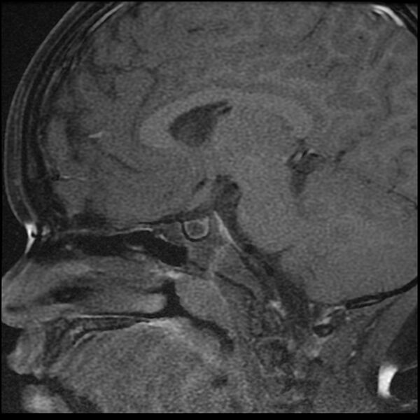 File:Adamantinomatous craniopharyngioma (Radiopaedia 77407-89529 Sagittal T1 C+ fat sat 10).jpg