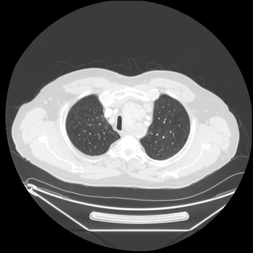 Adenocarcinoma of the lung (Radiopaedia 44876-48759 Axial lung window 12).jpg