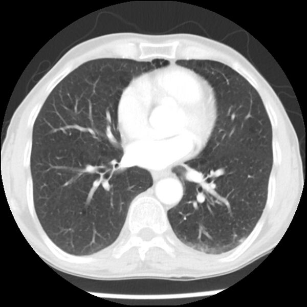File:Adenocarcinoma of the lung - micropapillary predominant (Radiopaedia 42446-45563 Axial lung window 44).jpg