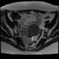 Adenomyosis and endometriotic cysts (Radiopaedia 82300-96367 Axial T2 19).jpg