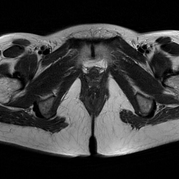 File:Adenomyosis within a septate uterus (Radiopaedia 69963-79981 Axial T2 30).jpg