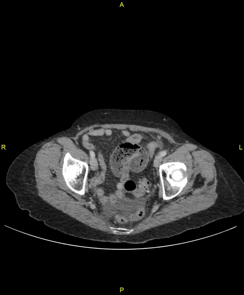 Adhesional small bowel obstruction (Radiopaedia 85402-101024 Axial C+ portal venous phase 253).jpg