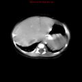 Adrenal hemorrhage (Radiopaedia 9390-10077 Axial C+ portal venous phase 2).jpg