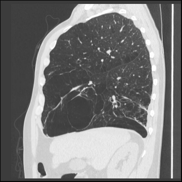 File:Alpha-1-antitrypsin deficiency (Radiopaedia 40993-43722 Sagittal lung window 188).jpg