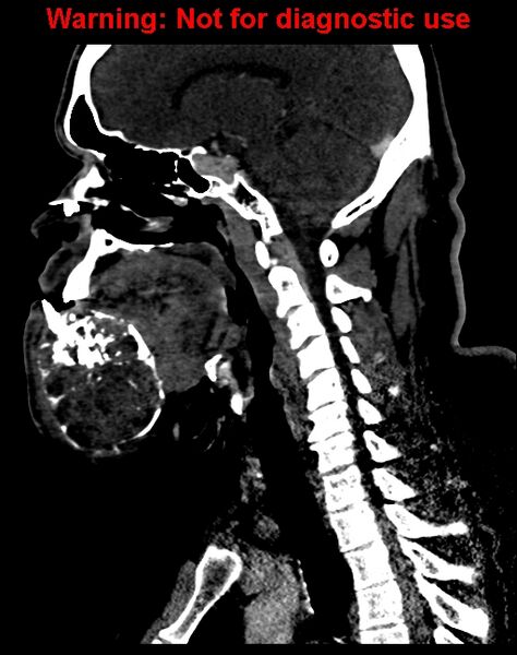 File:Ameloblastoma (Radiopaedia 33126-34164 F 40).jpg