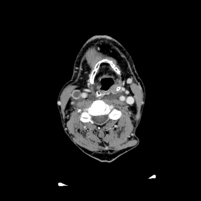 Anaplastic thyroid carcinoma (Radiopaedia 79087-92034 B 69).jpg