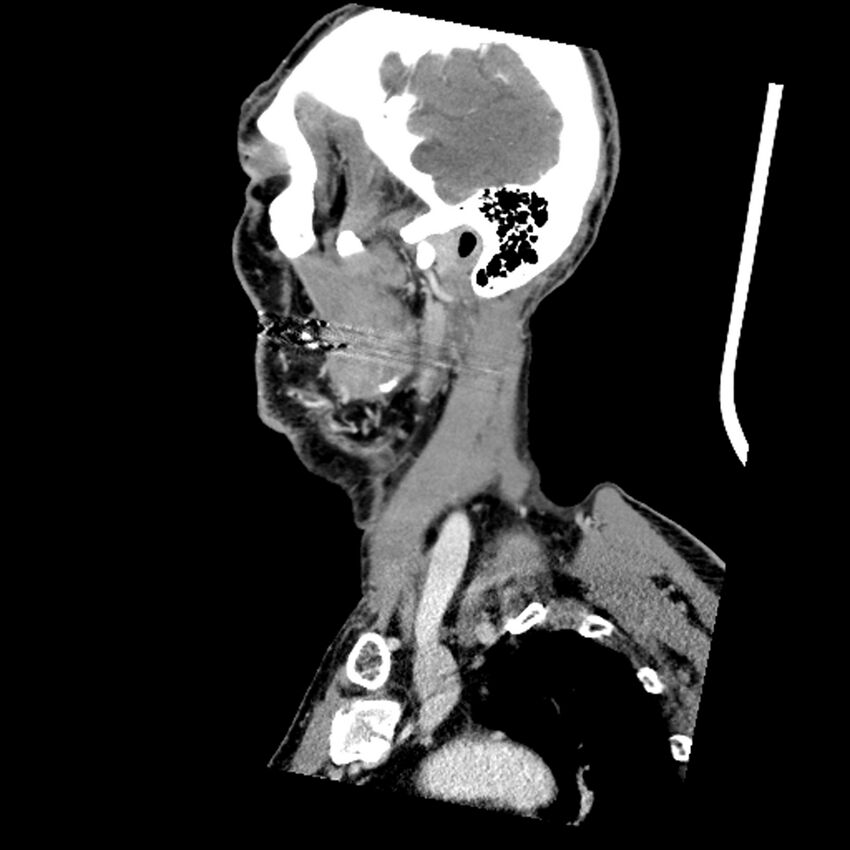 Anaplastic thyroid carcinoma (Radiopaedia 79087-92034 C 74).jpg