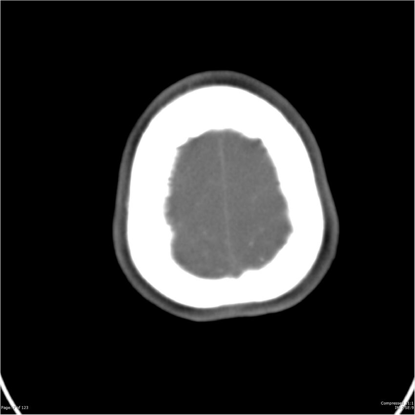 Aneurysmal subarachnoid hemorrhage and Moya Moya disease (Radiopaedia 34306-35593 Axial CT COW 7).jpg