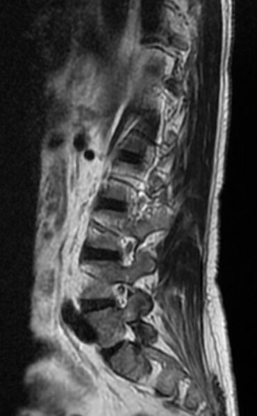 File:Ankylosing spondylitis - Andersson lesion (Radiopaedia 81878-95838 Sagittal T2 10).jpg