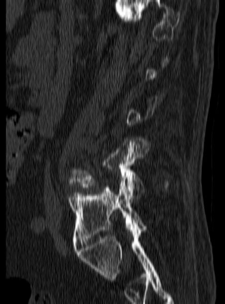 File:Ankylosing spondylitis complicated by fracture-dislocation (Radiopaedia 33583-34674 B 1).jpg