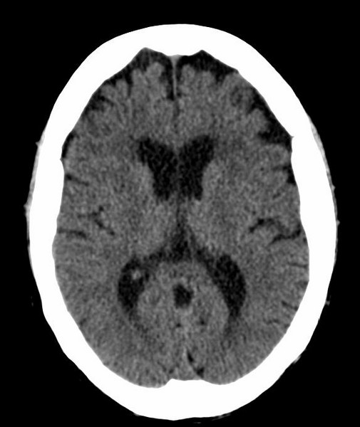 File:Anomalous intracranial venous drainage (Radiopaedia 28161-28418 Axial 20).png