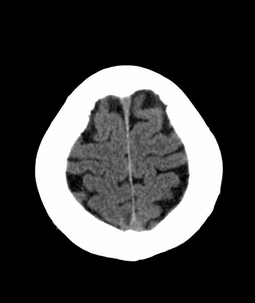 File:Anomalous intracranial venous drainage (Radiopaedia 28161-28418 Axial 52).png