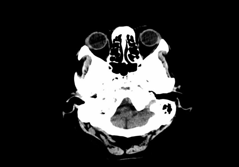File:Anomalous intracranial venous drainage (Radiopaedia 28161-28418 Axial non-contrast 5).jpg