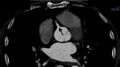 Anomalous left coronary artery- prepulmonic course (Radiopaedia 29253-29667 A 10).JPG