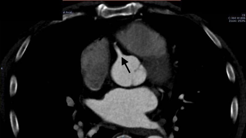 File:Anomalous left coronary artery- prepulmonic course (Radiopaedia 29253-29667 A 10).JPG