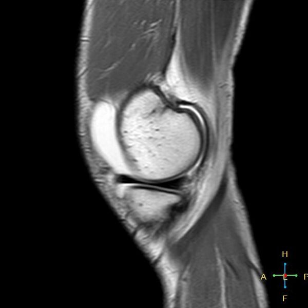 File:Anterior cruciate ligament tear - complete (Radiopaedia 24907-25170 Sagittal PD 16).jpg
