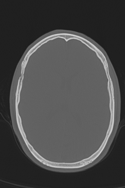 File:Anterior nasal spine fracture (Radiopaedia 46138-50494 Axial bone window 26).png