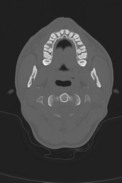 File:Anterior nasal spine fracture (Radiopaedia 46138-50494 Axial bone window 59).png