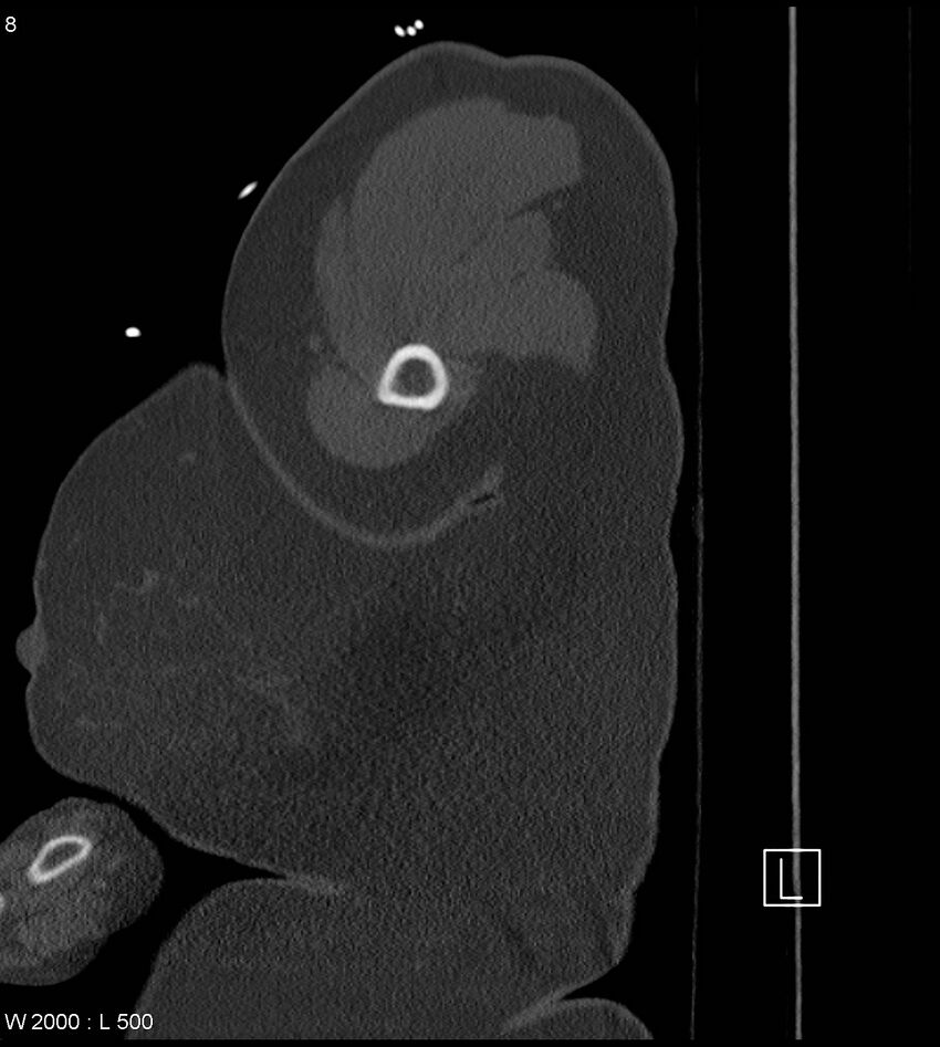 Anterior shoulder dislocation (CT) (Radiopaedia 59032-66309 Sagittal bone window 4).jpg