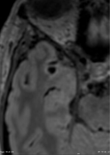 File:Anterior temporal lobe perivascular space (Radiopaedia 40946-43650 C 10).jpg