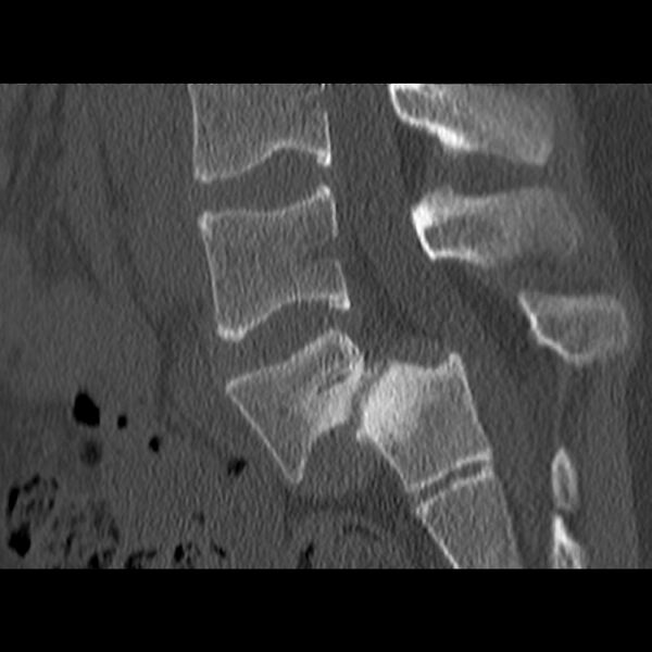 File:Anterolisthesis (Radiopaedia 22226-22263 Sagittal bone window 10).jpg