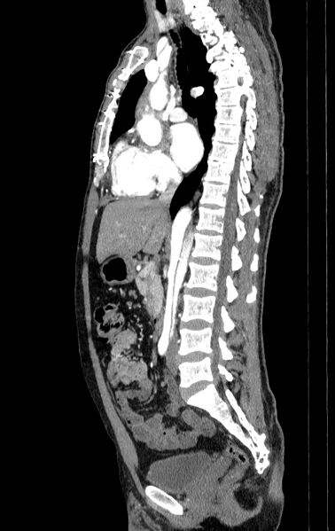 File:Aortic dissection - Stanford type A (Radiopaedia 83418-98500 B 28).jpg