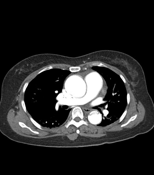 File:Aortic dissection with renal ischemia (Radiopaedia 76573-88338 A 29).jpg