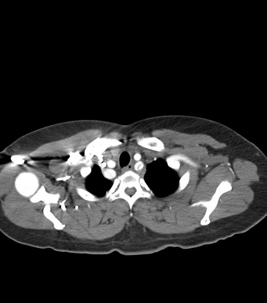 File:Aortic dissection with renal ischemia (Radiopaedia 76573-88338 A 5).jpg