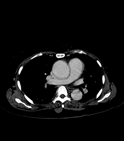 File:Aortic dissection with renal ischemia (Radiopaedia 76573-88338 B 13).jpg